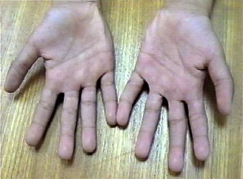 Triphalangeal Thumb – Clinical Eye Openers