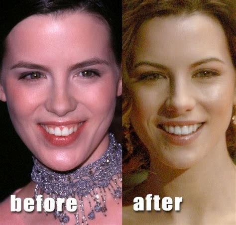 Kate Beckinsale Plastic Surgery Breast Implants, Nose Job Before and ...