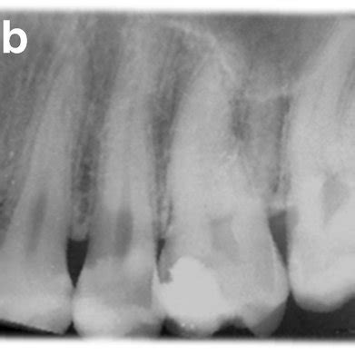 Pre-operative X-ray of tooth 4.6. | Download Scientific Diagram