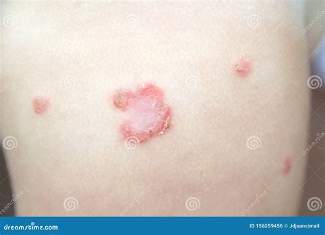 Impetigo On Arm