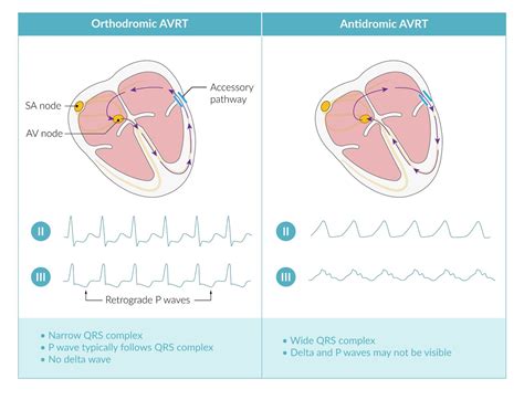 Common Types Of Supraventricular Tachycardia: Diagnosis And, 55% OFF