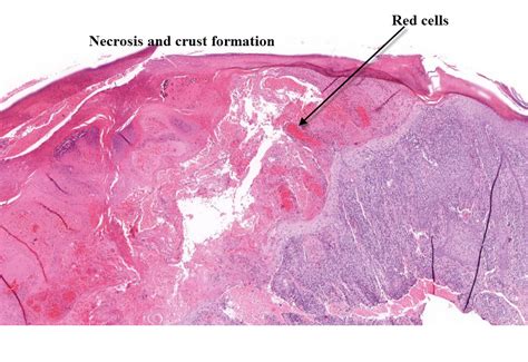 Dermatopathology Made Simple - Inflammatory: Pustular Reaction Pattern