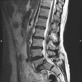 mri procedures and pathology: lumbar spondylolisthesis