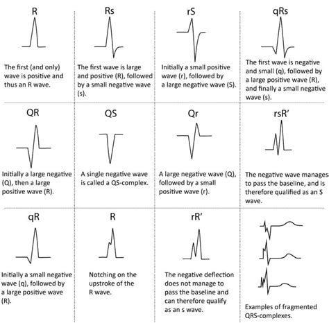 Pin by Alice Boxall on Medicine | Ecg interpretation, Ekg rhythms, Ekg ...