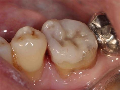 Treatment Options: Dental Aesthetic with White Filling II (On Back Teeth)