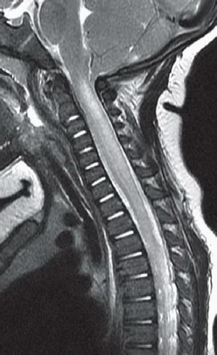 Acute Transverse Myelitis | Radiology Key