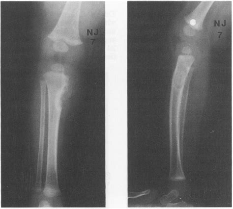 & 4 The same patient at 7 months. An excisional biopsy was performed ...