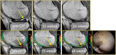 Mri Knee Cartilage Damage