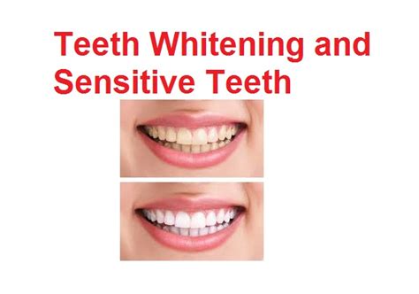 Teeth Whitening and Sensitive Teeth