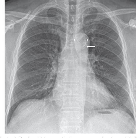 Figure 2 from The clinical significance of aortic calcification in ...