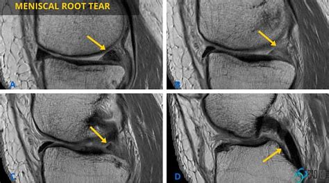 Posterior Horn Medial Meniscus Root Tear