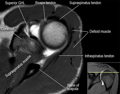 MRI Musculo-Skeletal Section: How to locate glenohumeral ligaments.