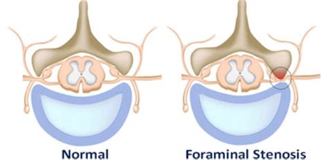 What is Neural Foraminal Stenosis (bilateral, mild, moderate, severe) Treatment | Health and ...