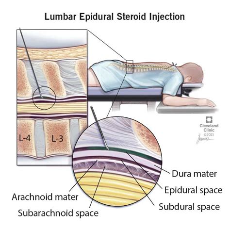 Epidural side effects – Artofit