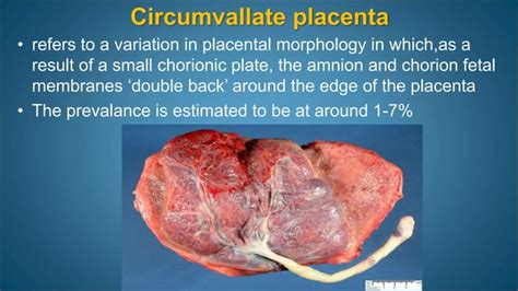 Antepartum Hemorrhage