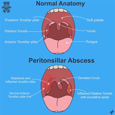 Peritonsillar Abscess Anatomy