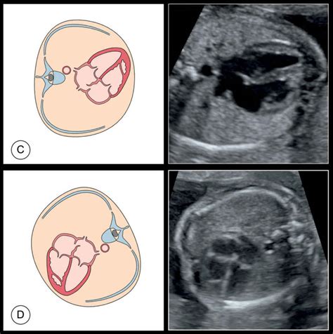 Fetal Cardiac Axis Normal Range - PELAJARAN