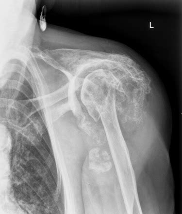 Milwaukee shoulder | Image | Radiopaedia.org