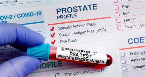 PSA Blood Test | Florida Center For Prostate Care - Jacksonville, Florida