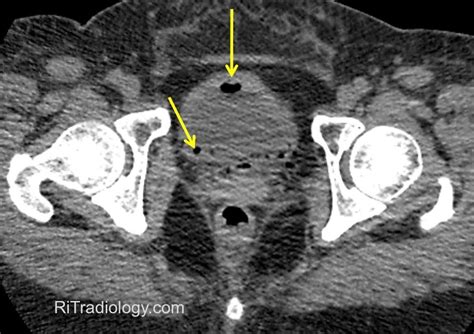 RiT radiology: Emphysematous Cystitis