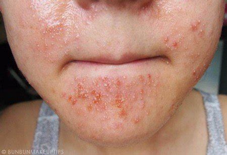 Everything about skin allergy, prevention, and home remedies