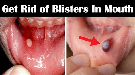 How to Get Rid of Blisters in Mouth Fast | Home Remedies for Blisters in Mouth and Tongue - YouTube