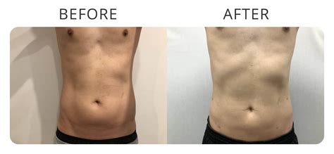 Liposuction Before And After Gallery - MCC Sydney