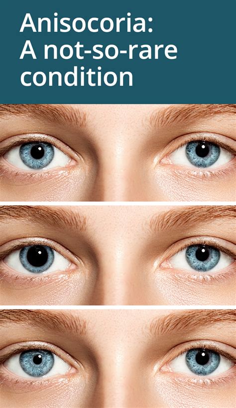 What is anisocoria? | Tıbbi, Doktorlar, Gözler