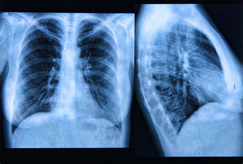 Lung Transplantation for Cystic Fibrosis