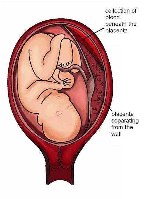 Retained Placenta 3 Weeks After Birth