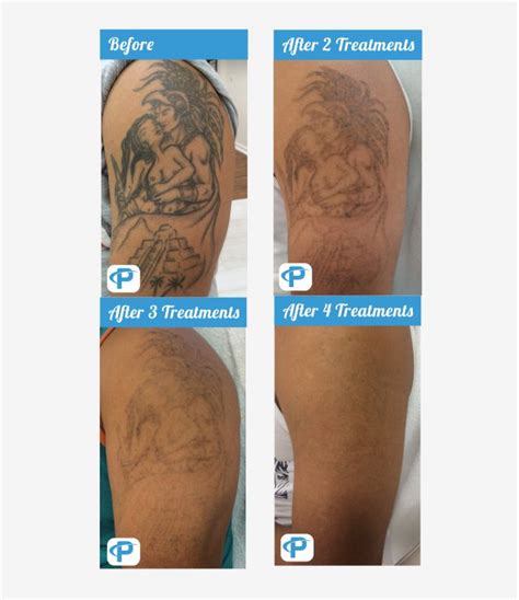 Laser Tattoo Removal Before and After Photos Premium Tattoo Removal