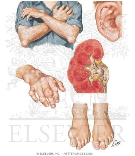 Tophaceous Gout Gouty Arthritis