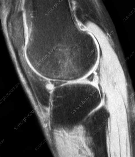 Knee Cyst Mri