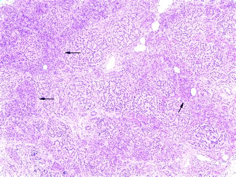 Pancreatic polypeptide cell hyperplasia of the pancreas | Journal of ...