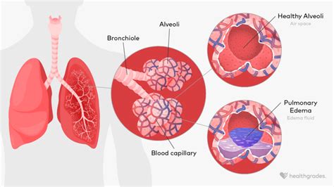 Pulmonary Edema: Symptoms, Causes, Treatments