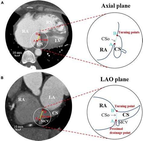 Frontiers | Association Between the Coronary Sinus Ostial Size and ...