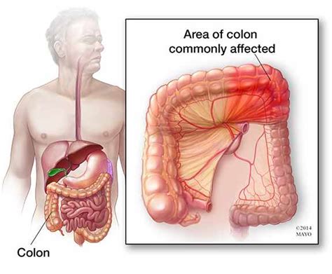 Weekend Wellness: Cause of ischemic colitis often unclear - Mayo Clinic News Network