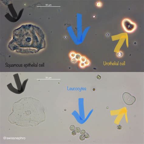 Urine Sediment of the Month: 4 Flavors of Nucleated Cells - Renal Fellow Network