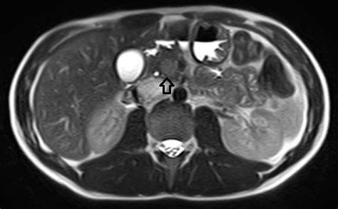 A: MRI (T2A) images of the abdomen. Arrow shows the hyperintense ...