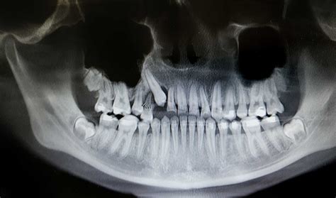 Orthognathic Surgery – Rocky Top Oral and Maxillofacial Surgery