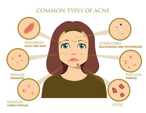 Acne: What causes acne problems?