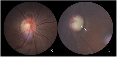 FIGURE E Fundus photographs showing a normal optic disc in the right ...