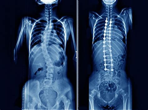 Cervical fusion surgery complications | doctorvisit