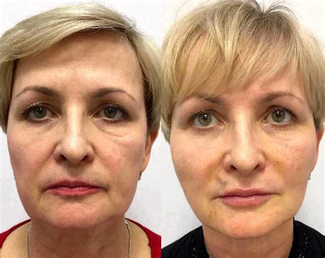 Y Lift Facelift Pictures Before And After » Facelift: Info, Prices, Photos, Reviews, Q&A