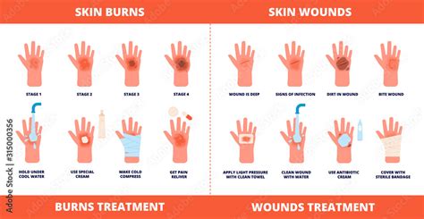 Skin first aid. Burns treatment, wounds and trauma symptoms. Degree burn, help hand healing with ...