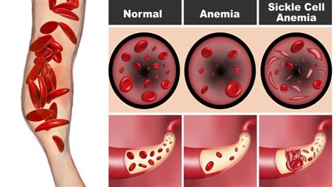 Doctors Explain the Causes and Signs of Sickle Cell Anemia