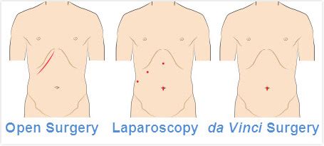 Gallbladder Disease (Cholecystectomy)|Southern Surgical Specialists