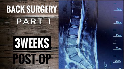 Back Surgery |Laminectomy L4-L5| Recovery part 1 - YouTube