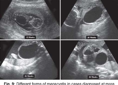 Prune-belly Syndrome versus Posterior Urethral Valve | Semantic Scholar