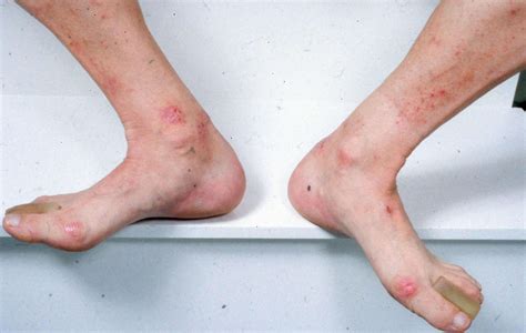 Dermatitis Herpetiformis (Celiac Disease Rash) Photos